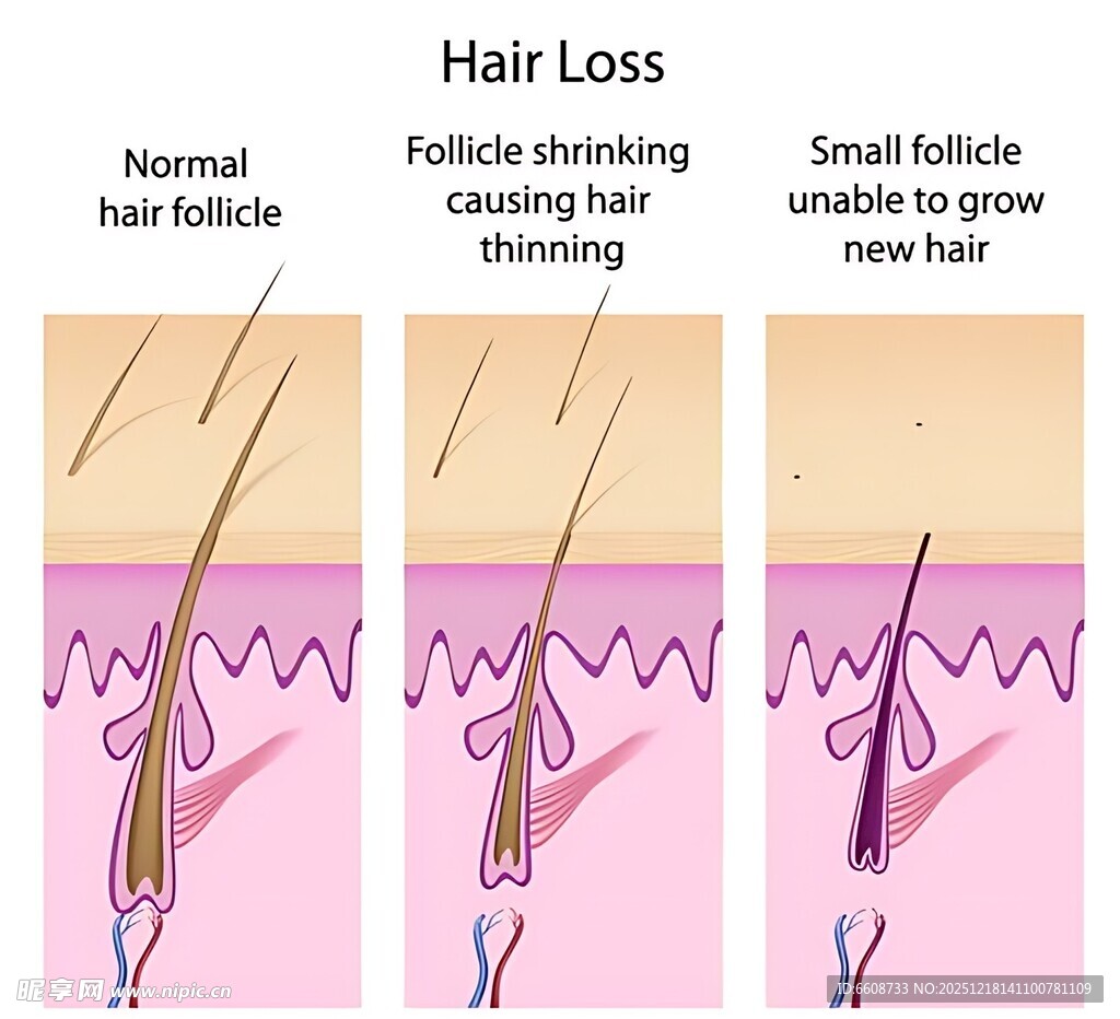 脱发过程图示