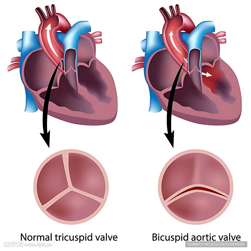 正常与二叶式主动脉瓣对比