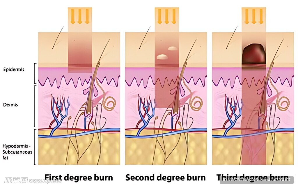 皮肤愈合不同阶段示意图