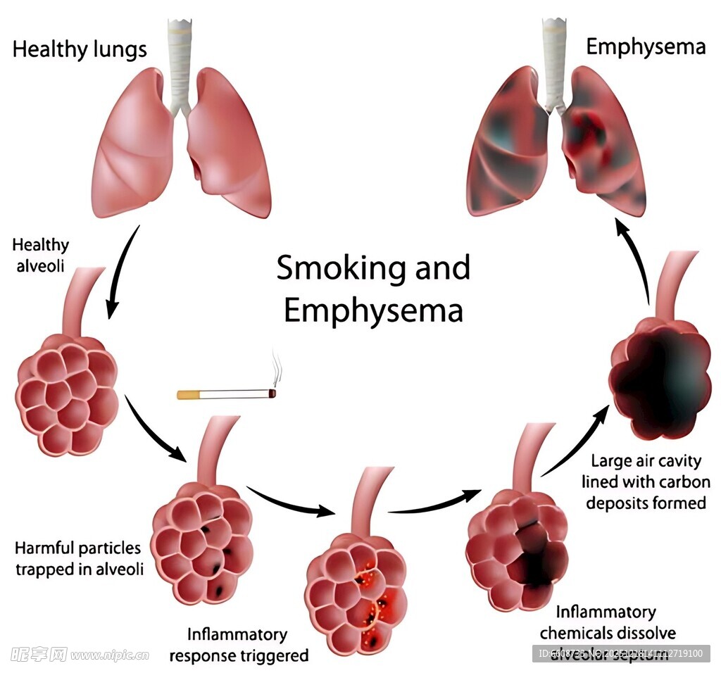 吸烟与肺气肿的关联图示
