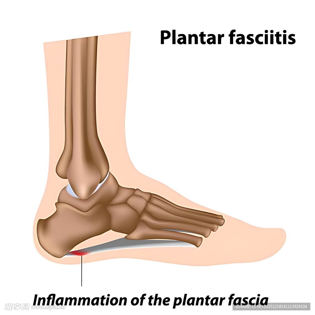 足底筋膜炎图示