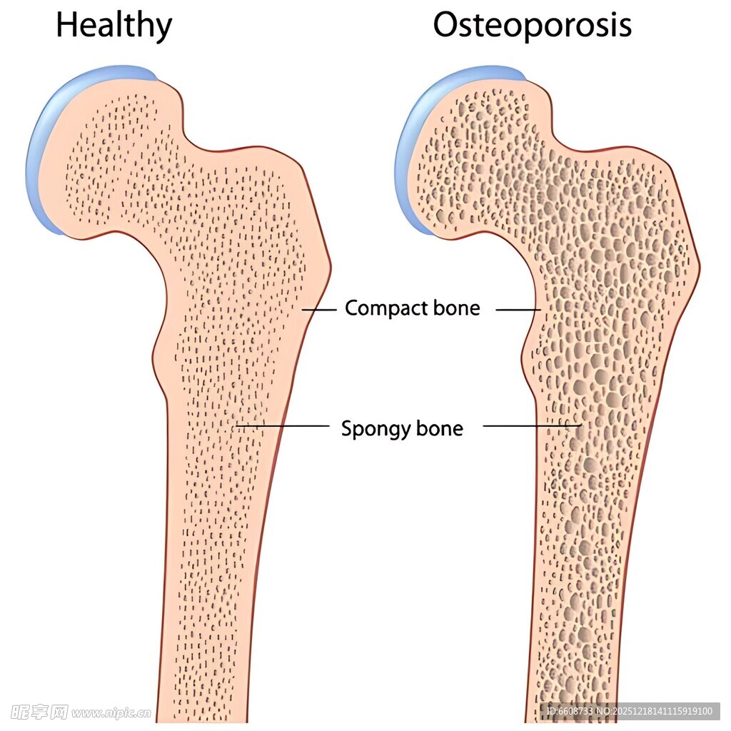 健康与骨质疏松骨骼对比