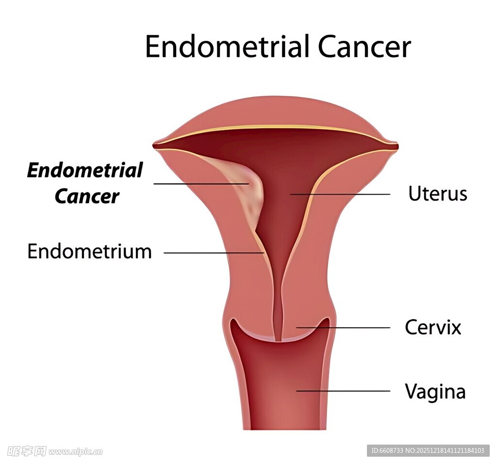 子宫内膜癌解剖示意图