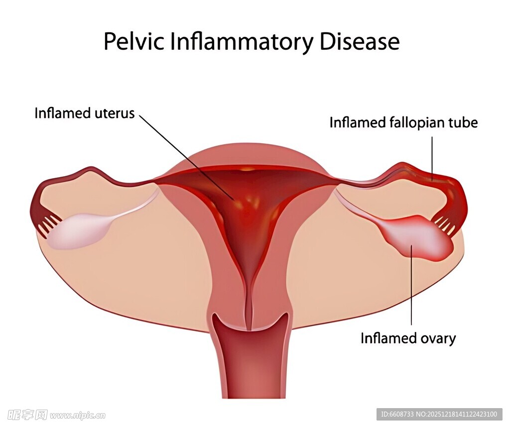 盆腔炎疾病图示