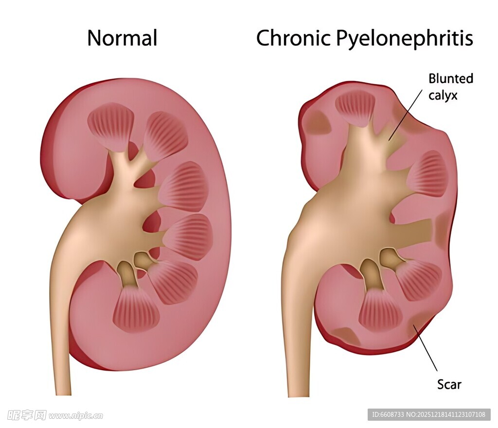 正常与充血性肾盂图解