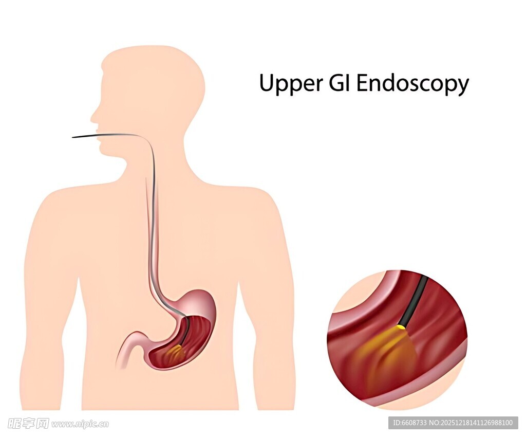 上消化道内窥镜检查示意图