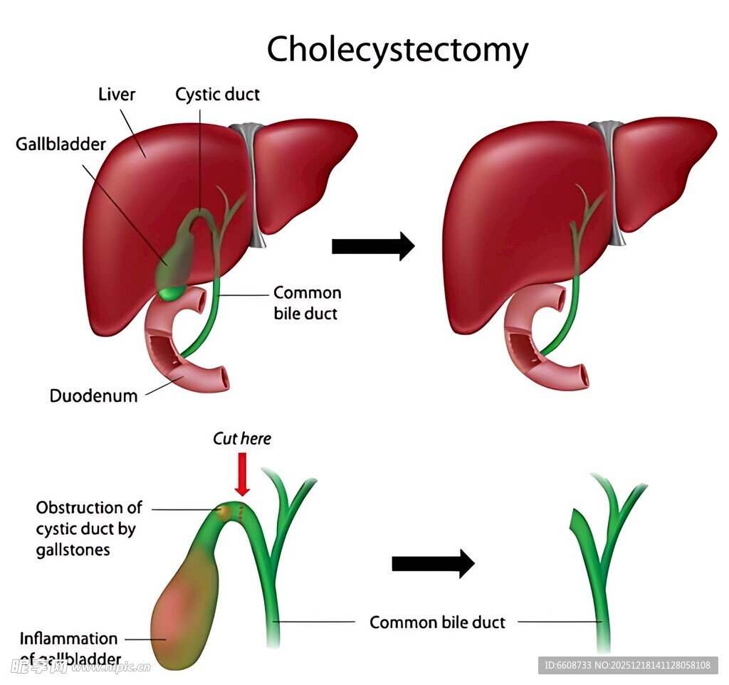胆囊切除术示意图