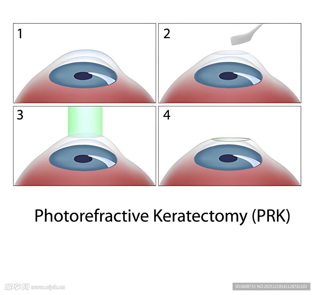 准分子激光角膜切削术步骤