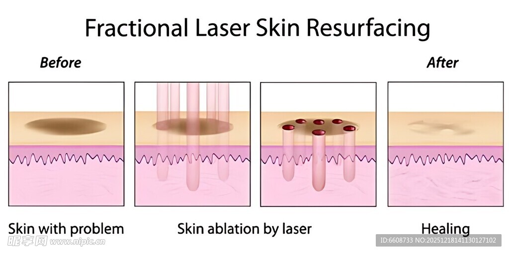 点阵激光换肤前后对比