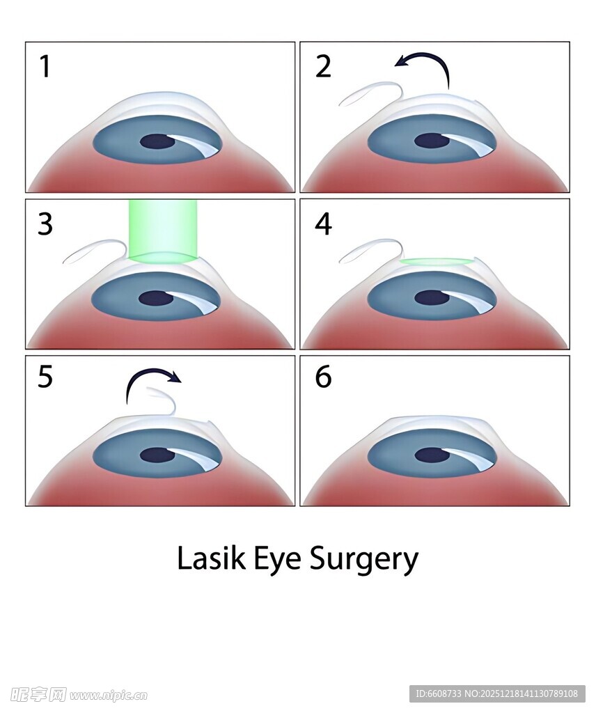 激光眼科手术步骤展示