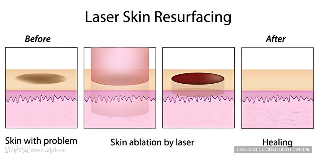 激光皮肤焕新过程图示