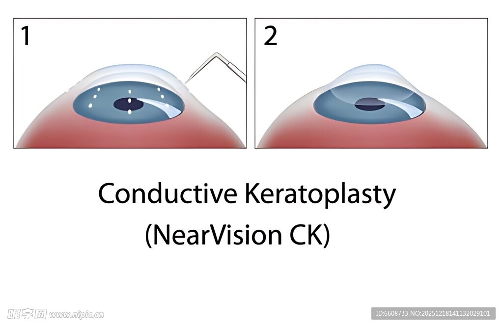 角膜传导性塑形术示意图