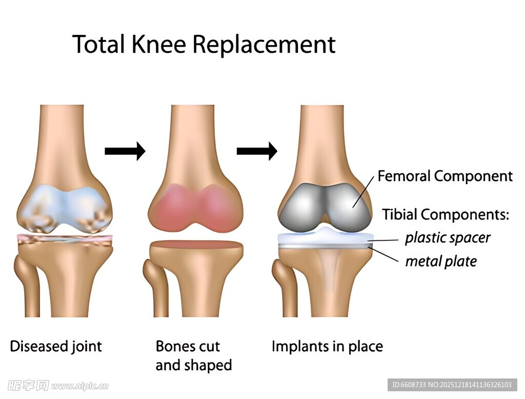 全膝关节置换示意图