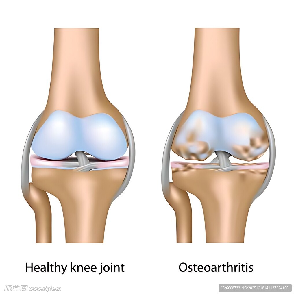健康与骨关节炎膝关节对比