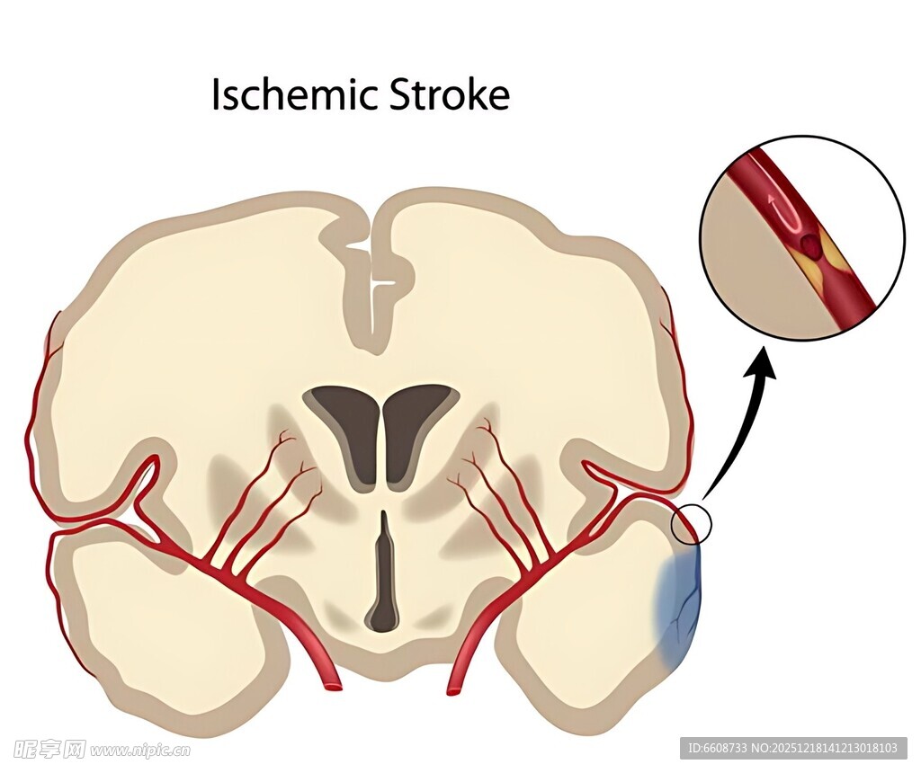 缺血性中风示意图