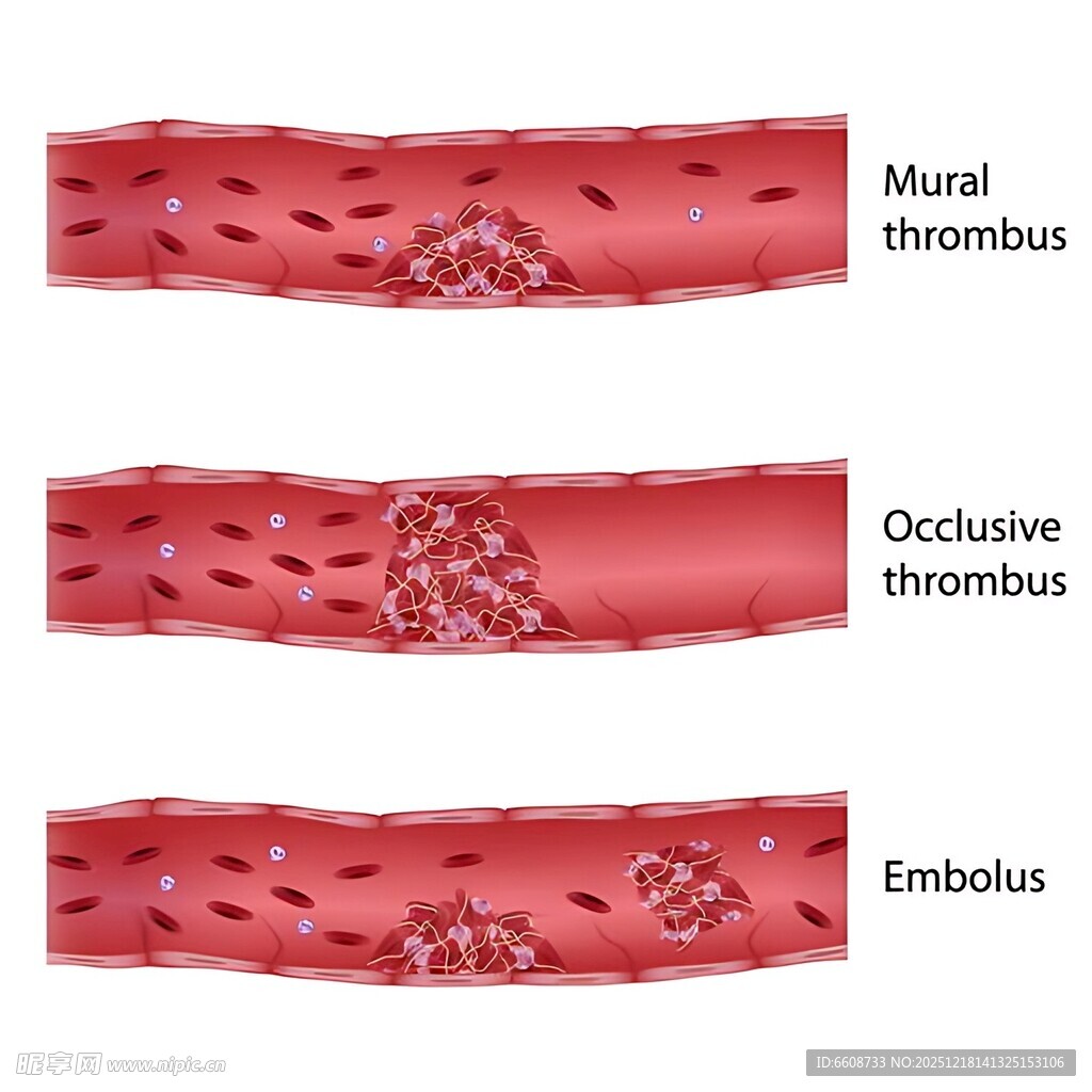血管内血栓类型展示