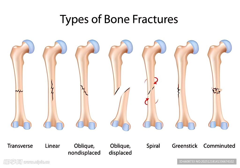 骨折类型示意图
