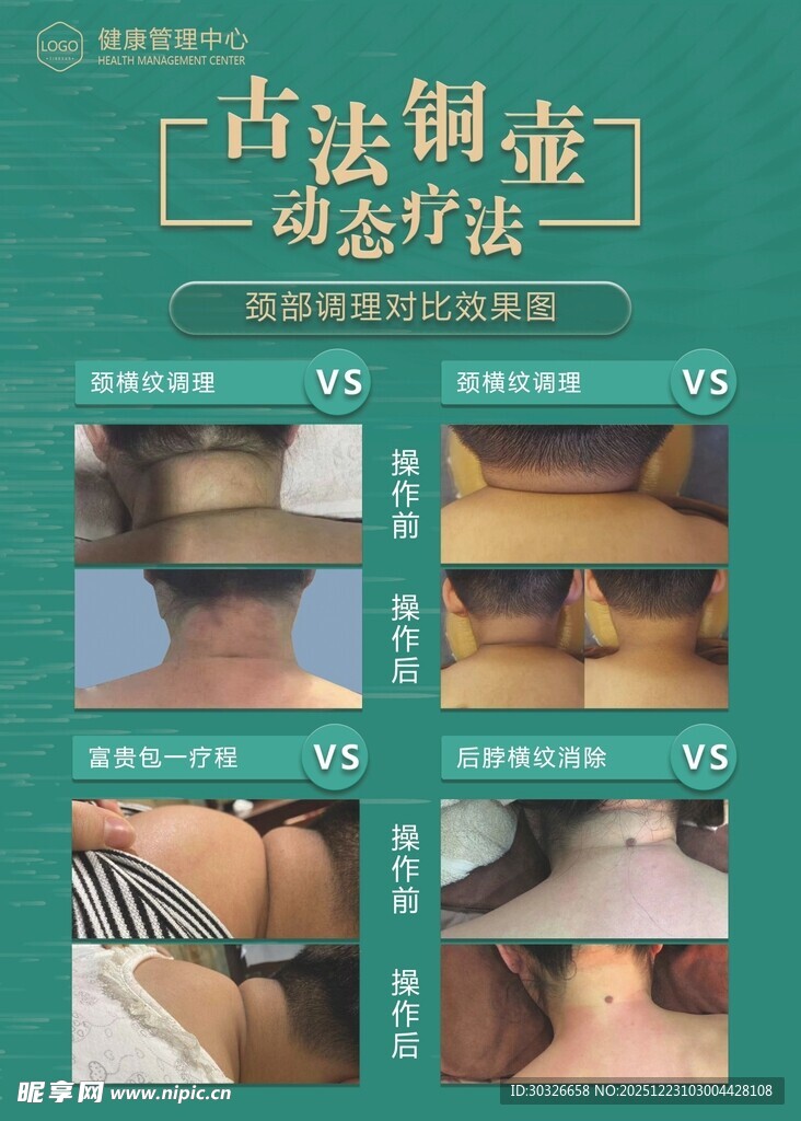 古法铜壶动态疗法操作对比图