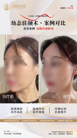 医美整形 幼态脸案例 对比 