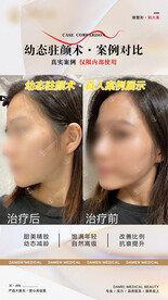 医美整形 幼态脸案例 对比 