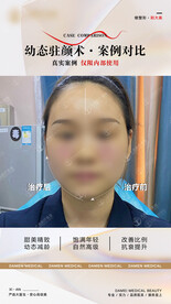 医美整形 幼态脸案例 对比 