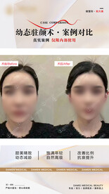 医美整形 幼态脸案例 对比 
