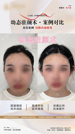 医美整形 幼态脸案例 对比 