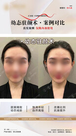 医美整形 幼态脸案例 对比 