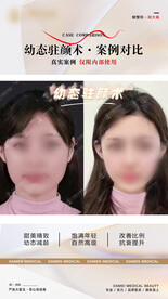医美整形 幼态脸案例 对比