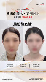 医美整形 幼态脸案例