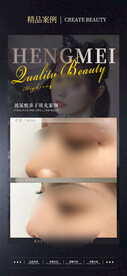 医美整形 隆鼻案例 鼻注射 