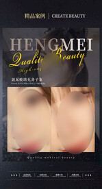 医美整形 隆鼻案例 鼻注射