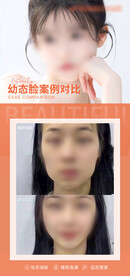 幼态脸案例