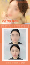 幼态脸案例