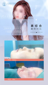 鼻综合案例