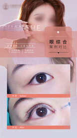 眼综合案例
