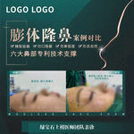 膨体隆鼻案例对比