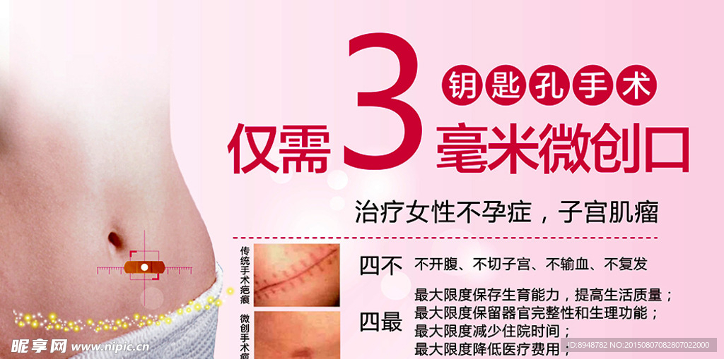 子宫肌瘤