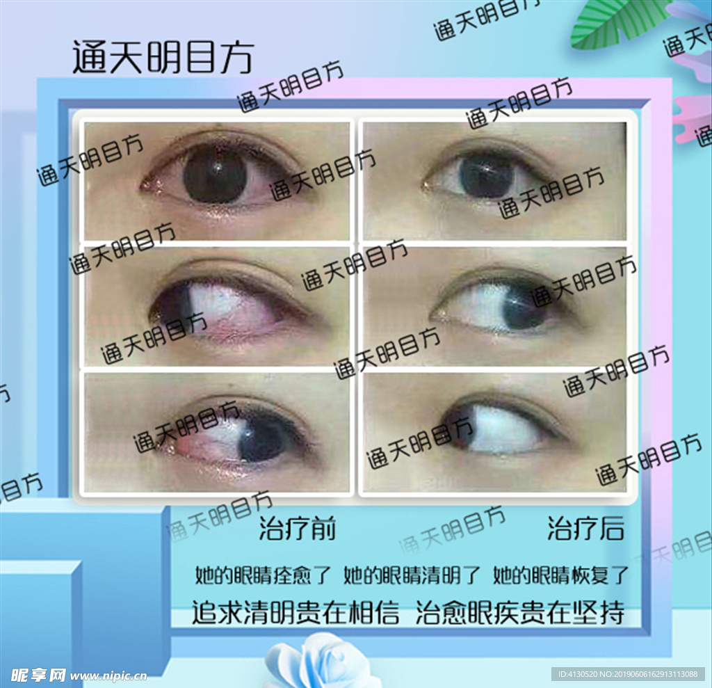 眼睛治愈前后对比