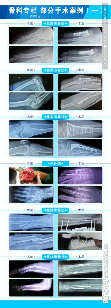 骨科手术案例展示