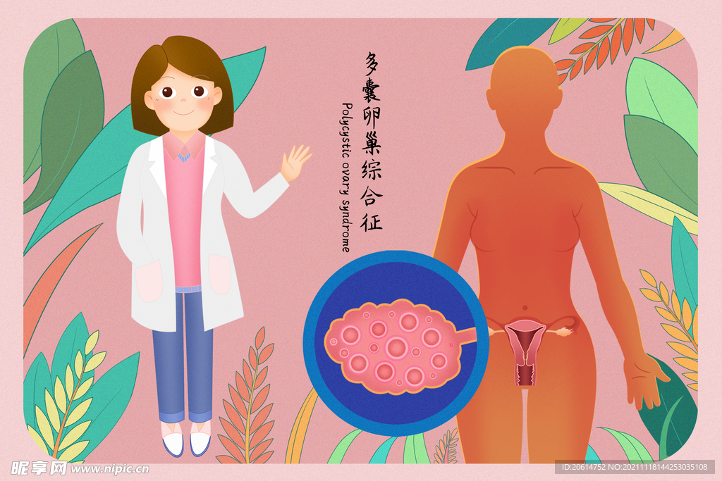 多囊卵巢综合症