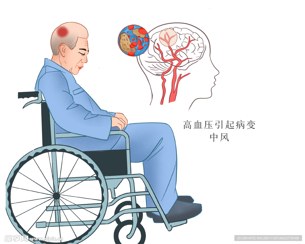 高血压并发症