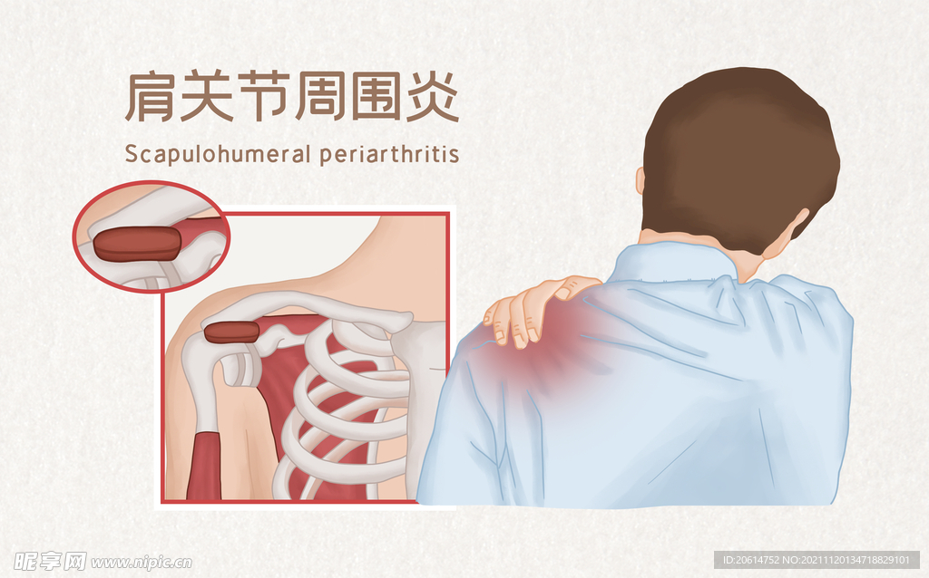 肩周炎