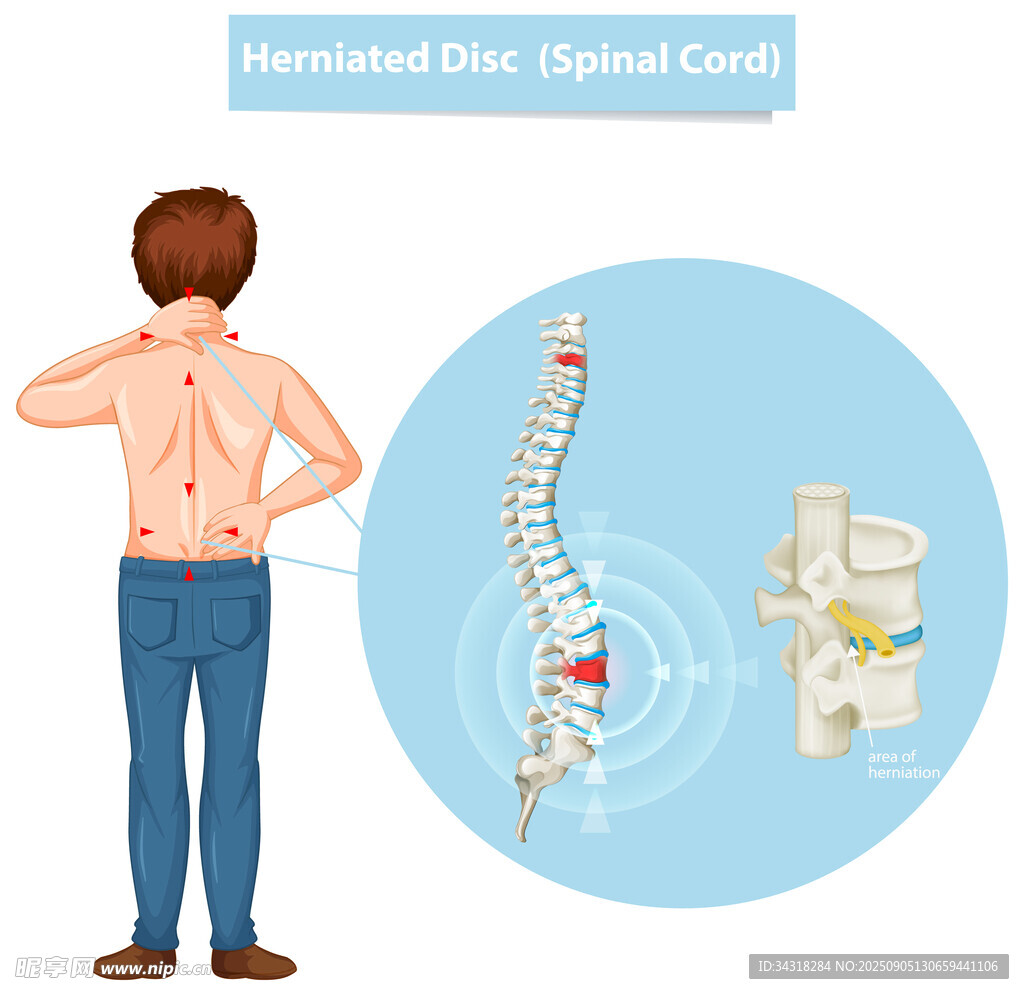 背部脊柱疼痛的健康示意