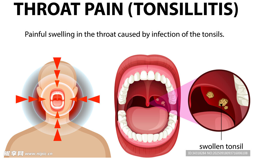 扁桃体炎引发的喉咙疼痛