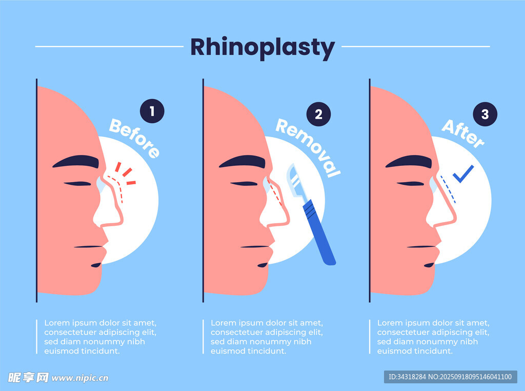 隆鼻手术步骤示意图
