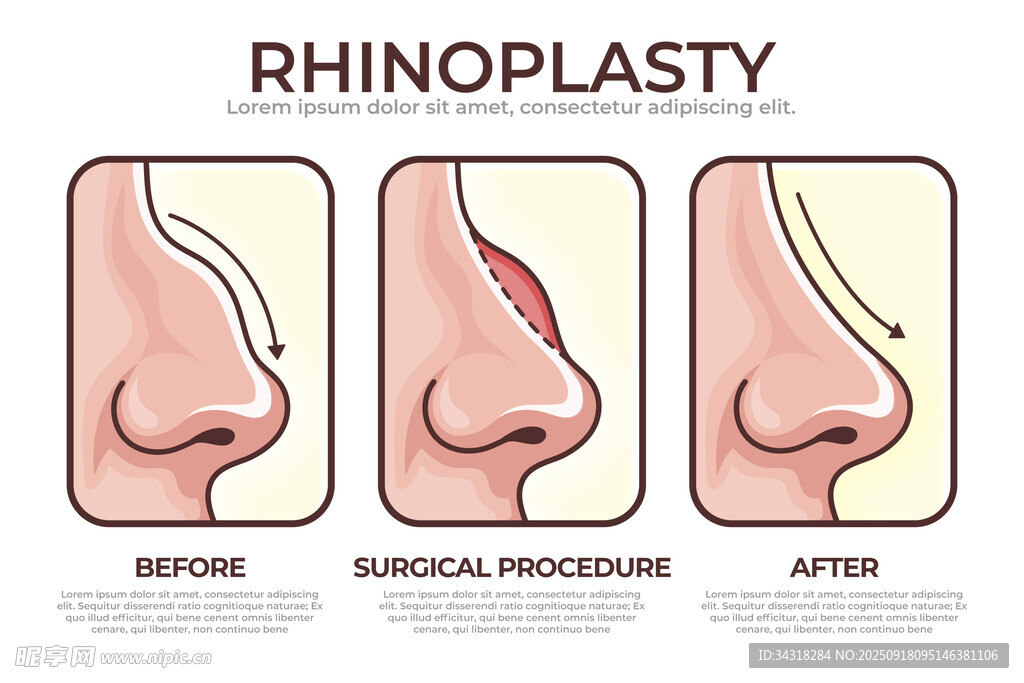 鼻手术前后对比图