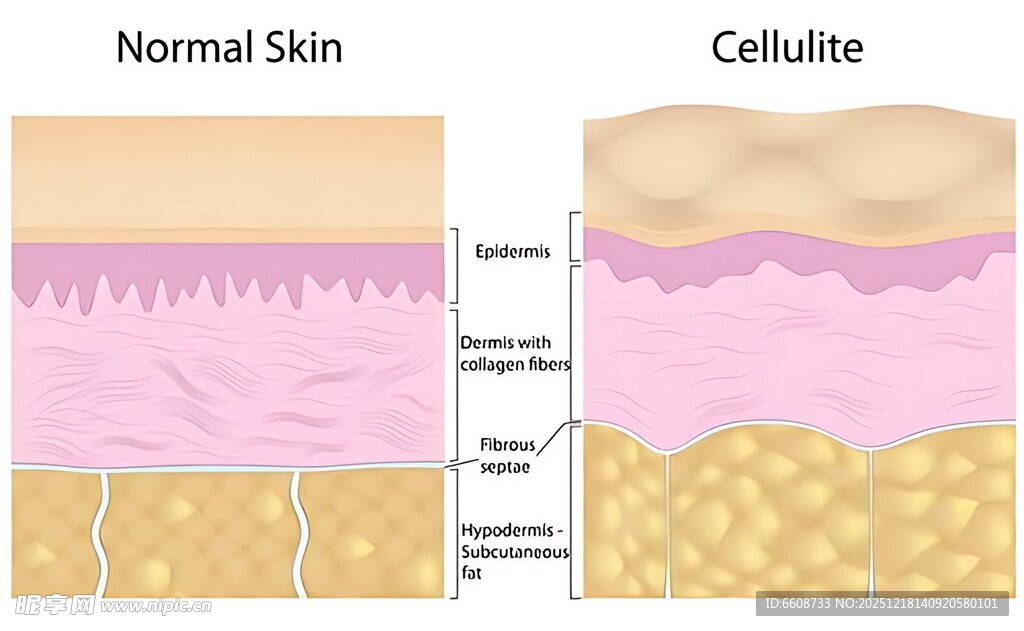 正常皮肤与橘皮组织对比