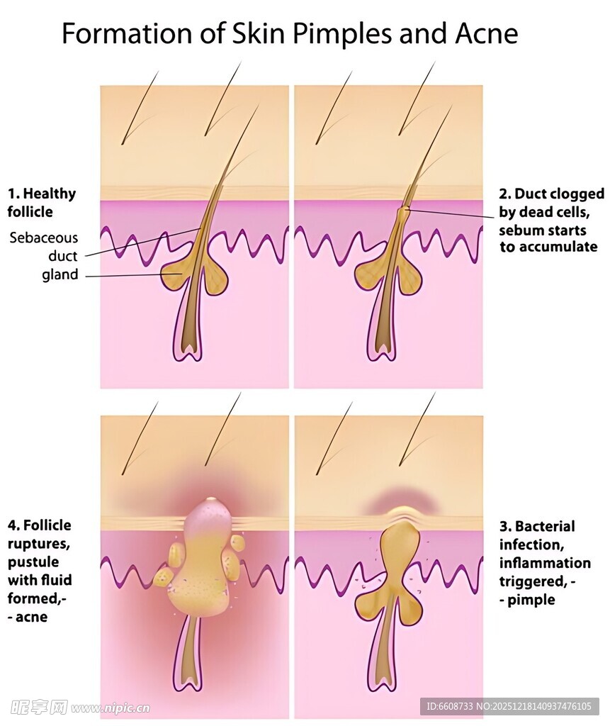 皮肤粉刺与痤疮形成过程
