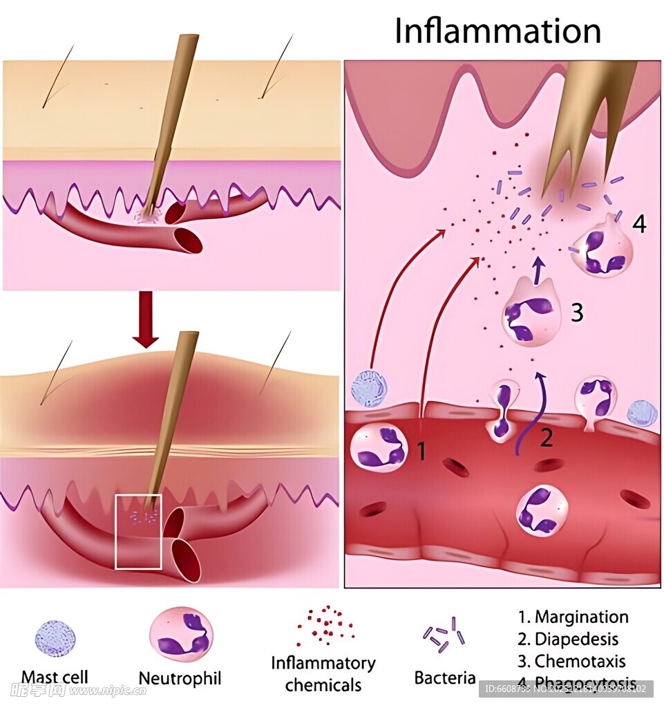 皮肤炎症机制示意图